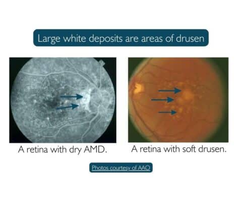 Fundus photos of retina with drusen in dry macular degeneration