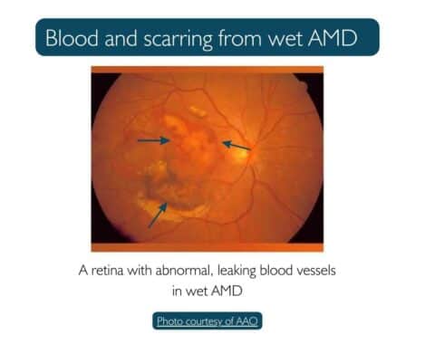 Fundus photo of leaking blood vessels and scarring from wet macular degeneration